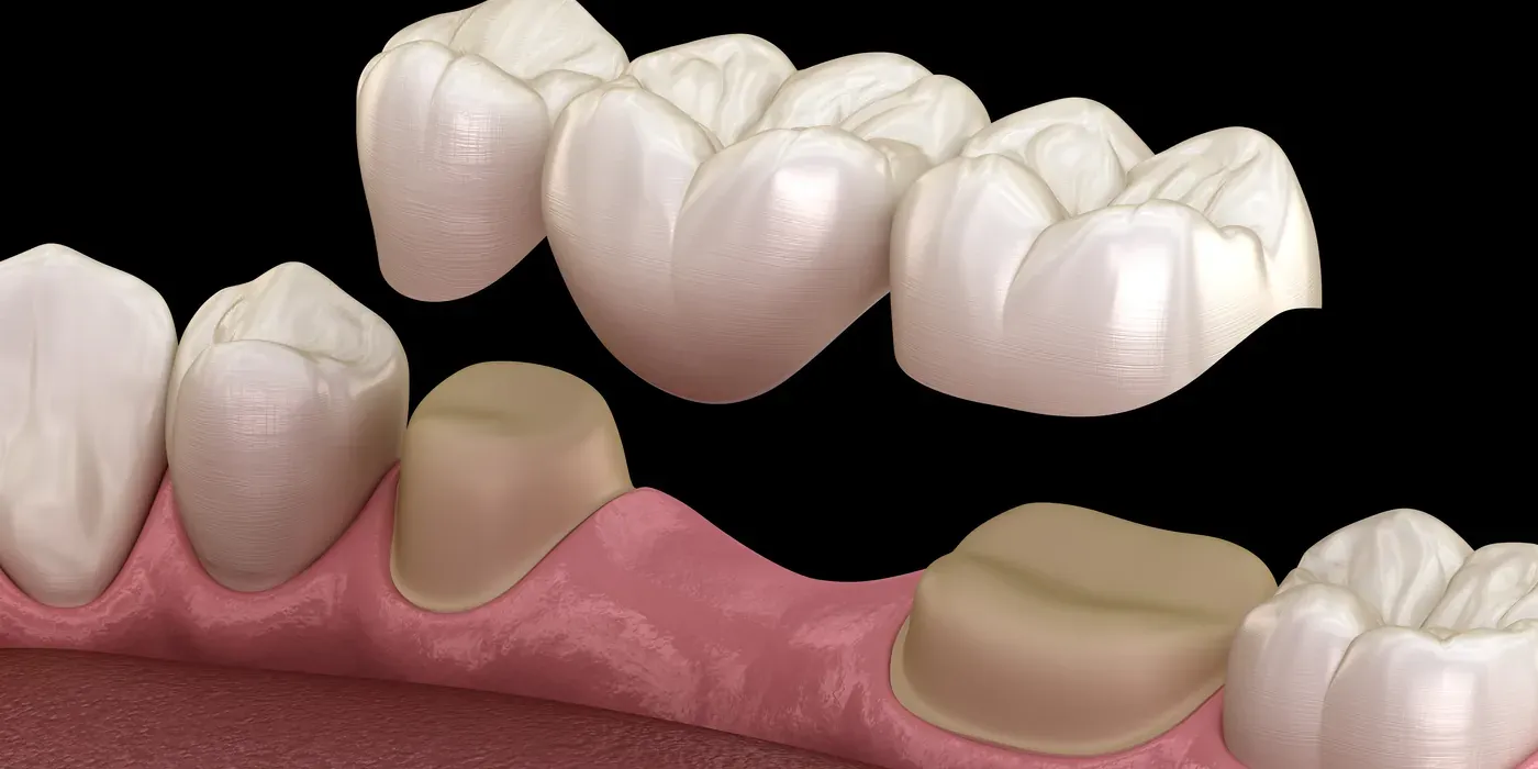 A three-unit dental bridge being lowered onto two prepared supporting teeth