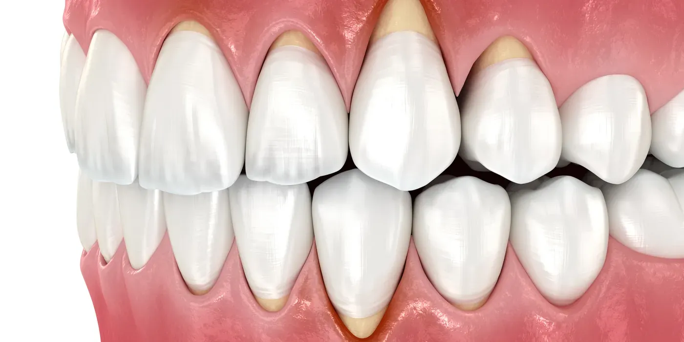 Gums receded from the teeth, exposing root surfaces — a common sign of gum disease