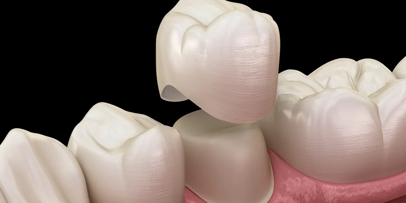 A porcelain crown positioned above a prepared tooth before placement