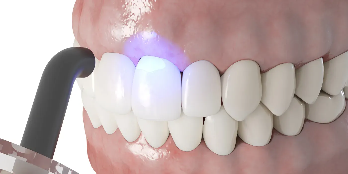 A curing light hardening tooth-colored composite bonded to a front tooth