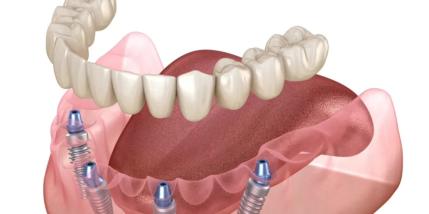 A full-arch denture supported by four dental implants in the lower jaw