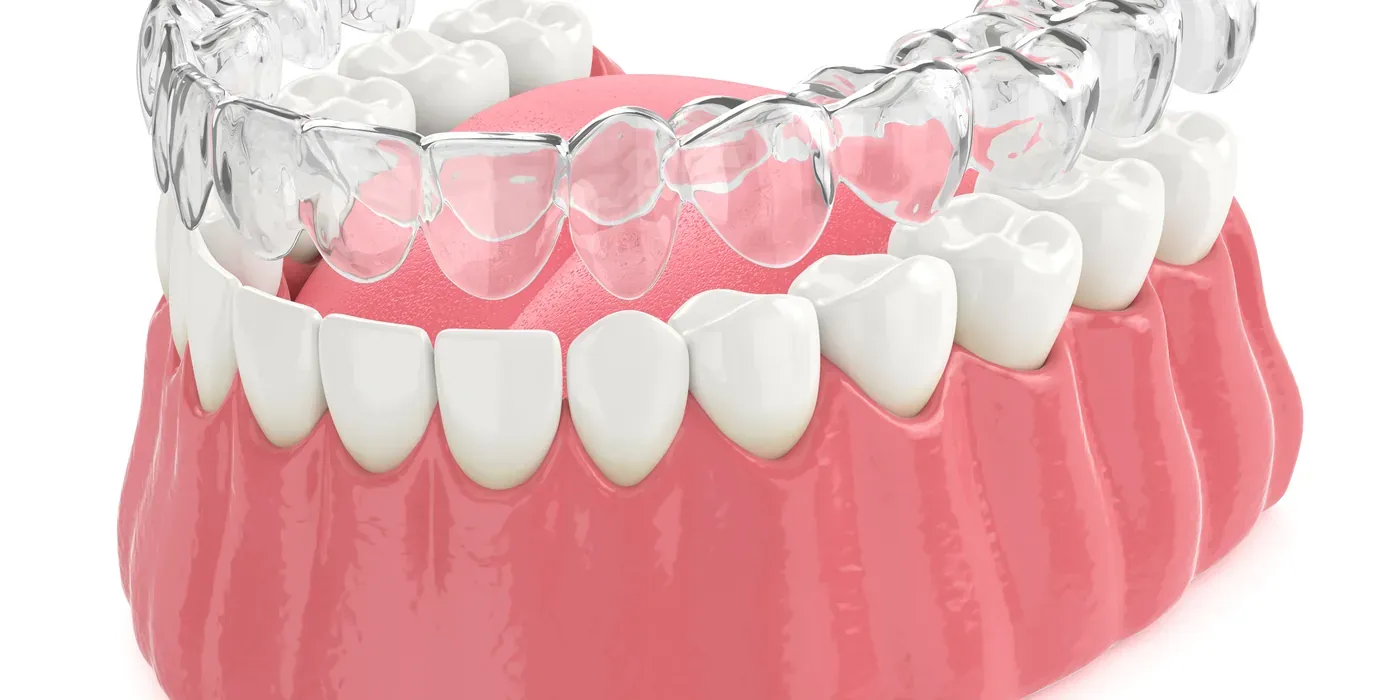 A clear Invisalign aligner tray fitted over the lower arch of teeth