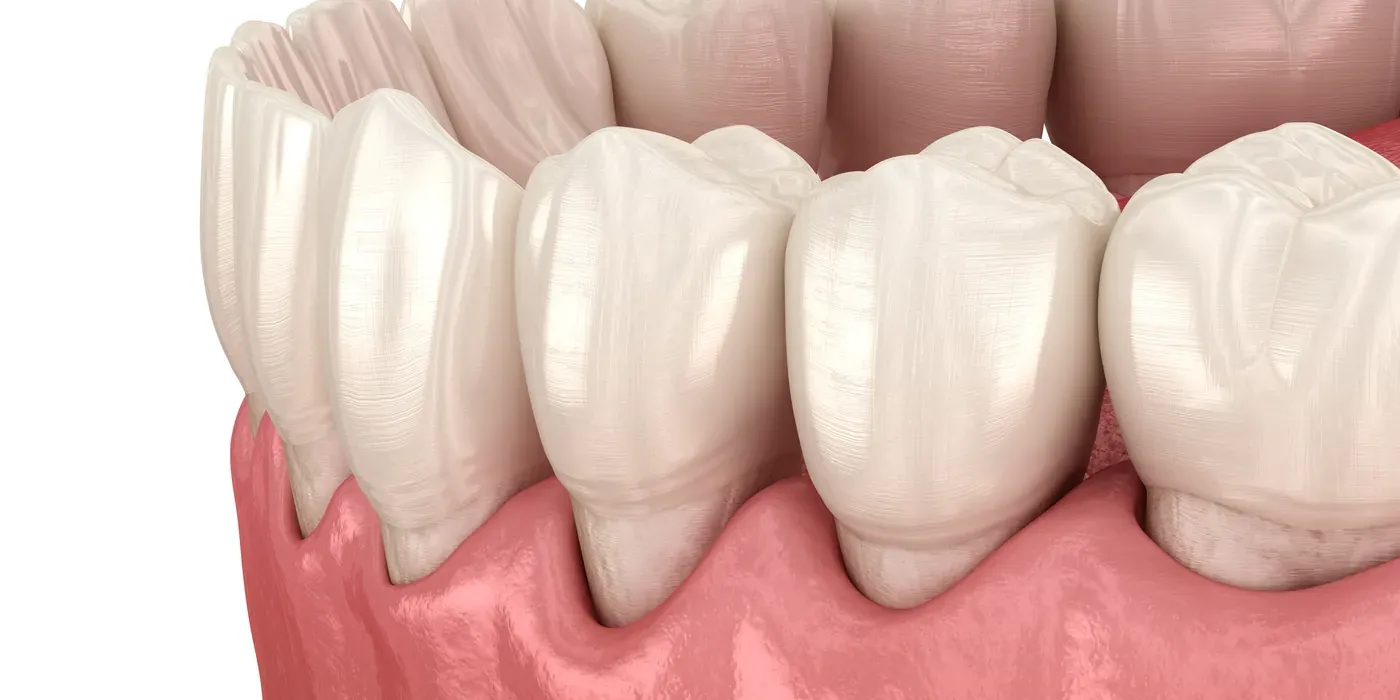 Gums receded away from the teeth, exposing the root surfaces
