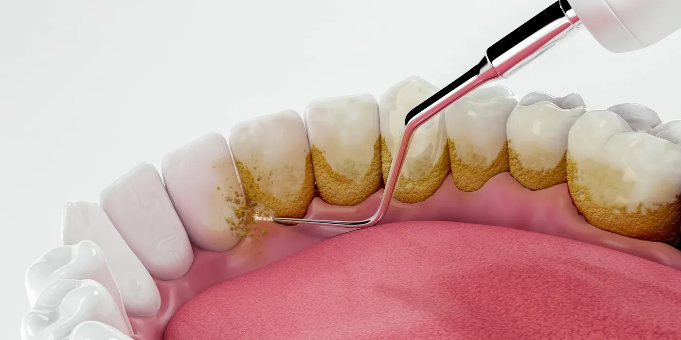 An ultrasonic scaler clearing buildup at the gumline during a periodontal maintenance visit