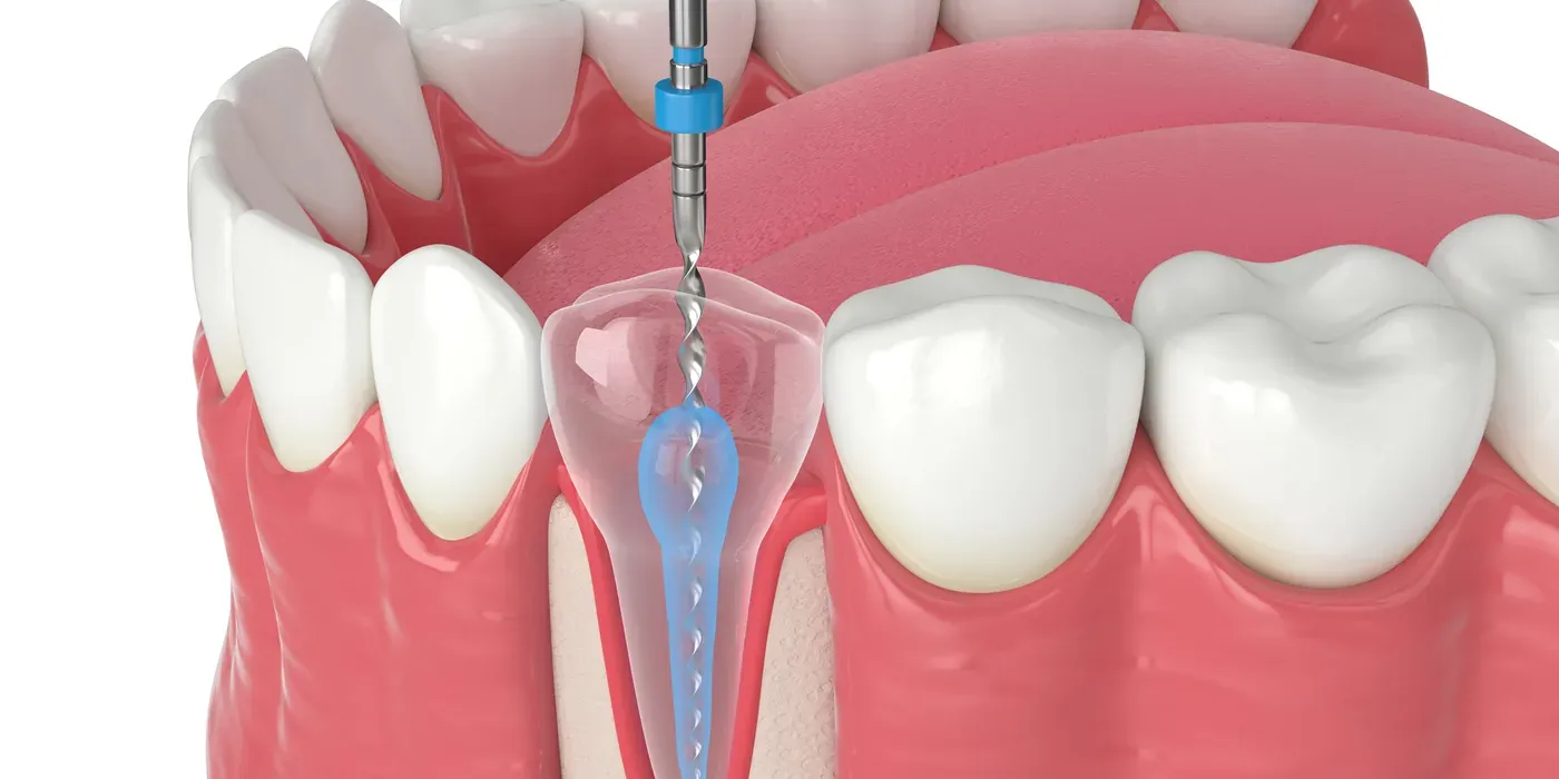 A cross-section of a tooth showing a file cleaning the inner canal during root canal therapy