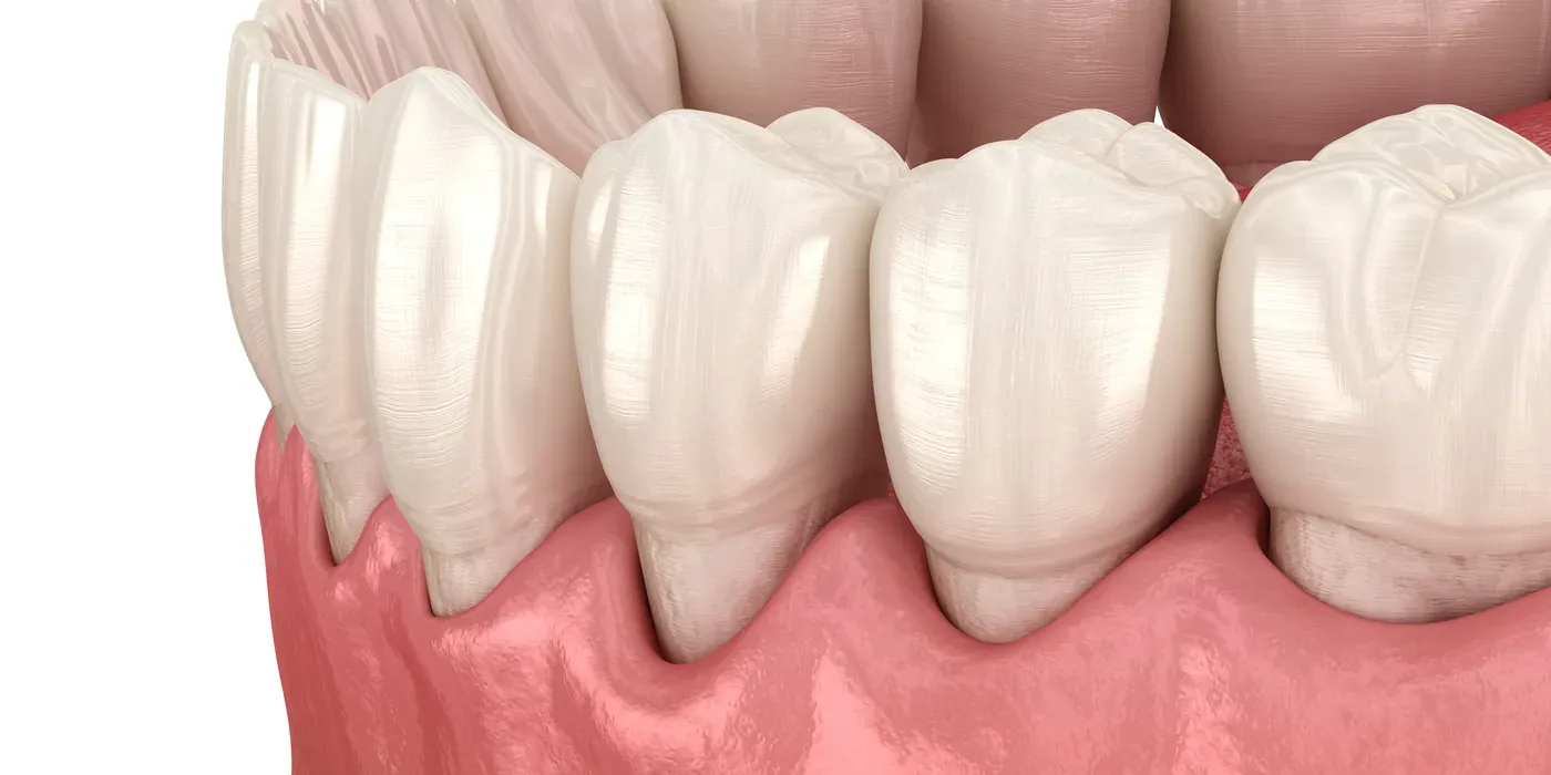 Gums receded from the teeth with exposed root surfaces, the condition scaling and root planing treats