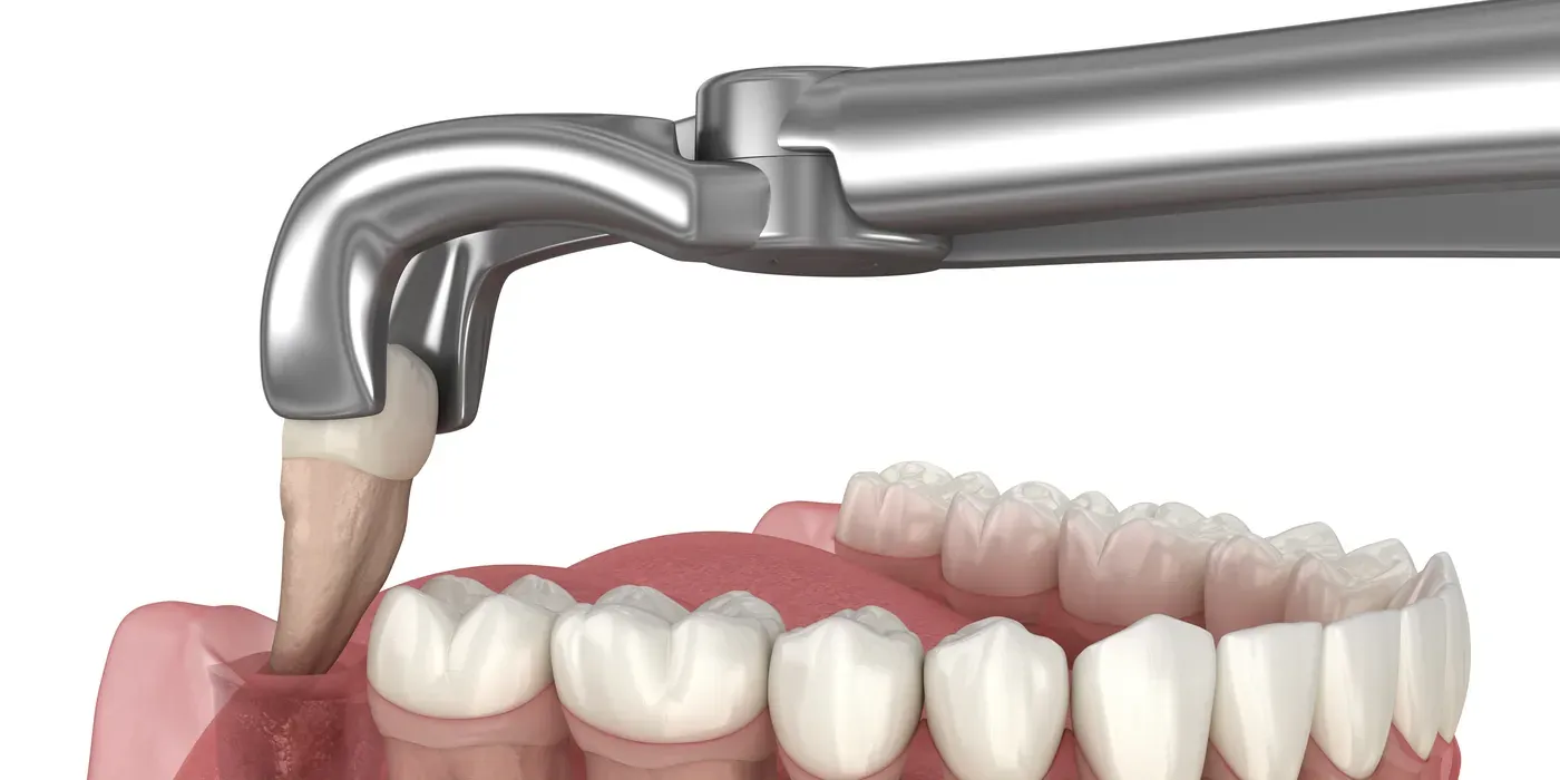 Dental forceps lifting an extracted tooth away from the arch