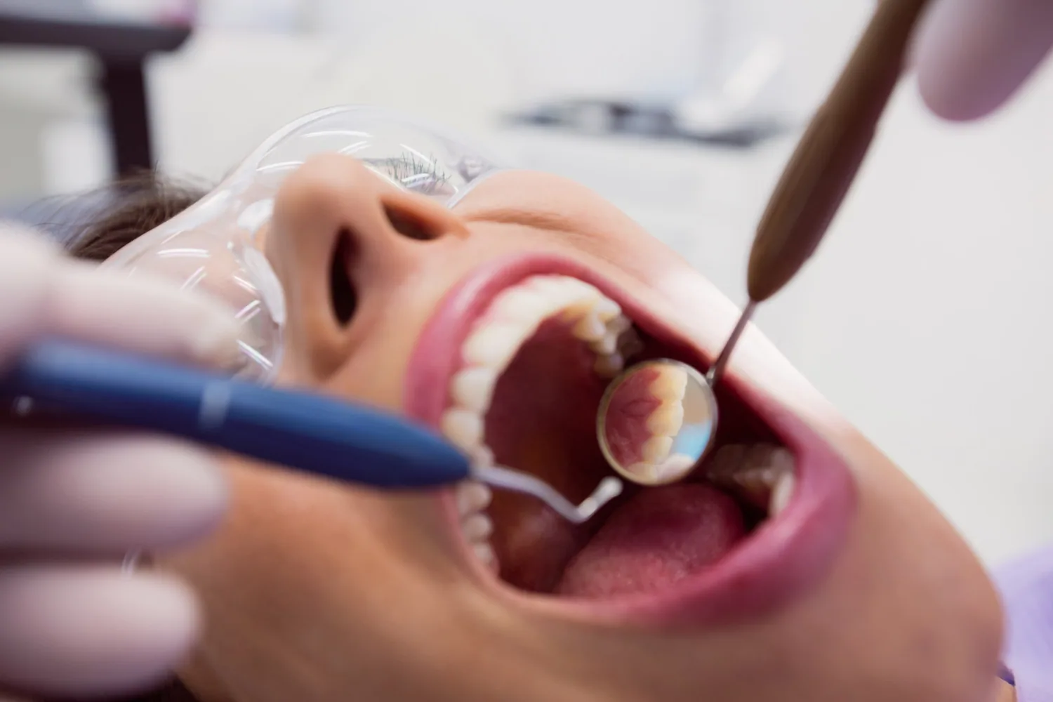 Cavity Risk