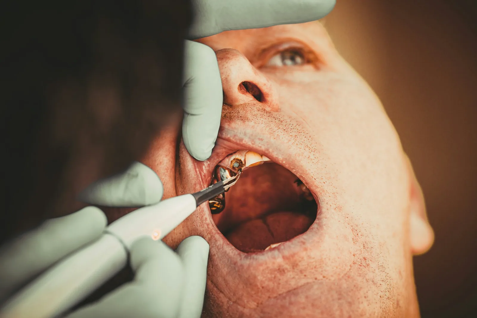 emergency tooth extraction