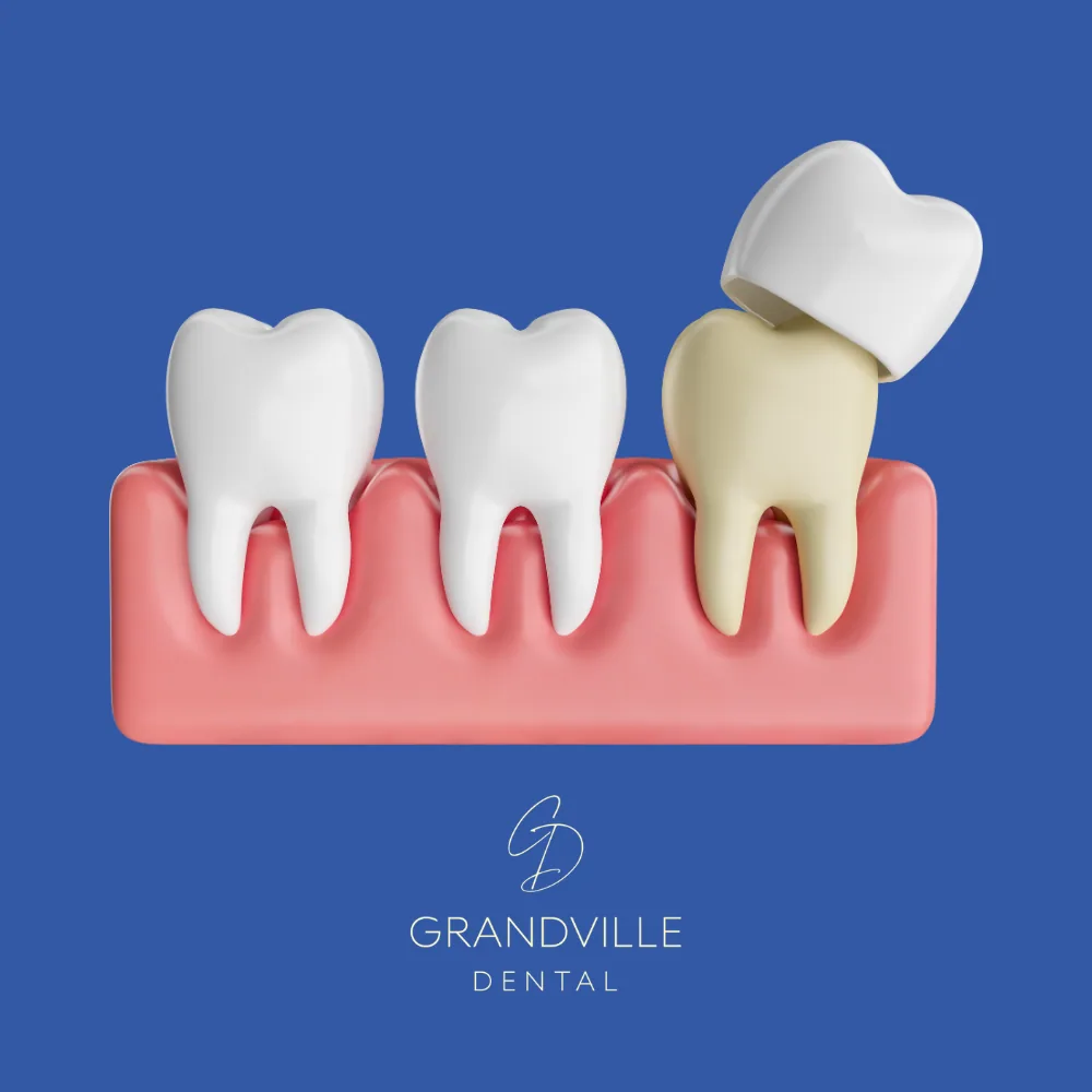 Dental Crowns