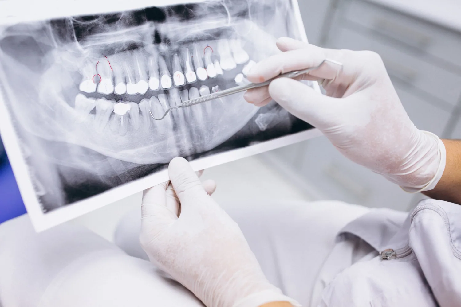 Root Canal
